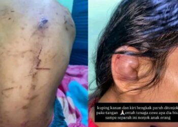 Diduga Jadi Korban KDRT, ART di Gunung Putri Bogor Alami Luka Sejumlah Bagian Tubuh, Publik Desak Polisi Bertindak Tegas 18